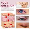 Gzwccvsn Stye Soothing Eye Serum Relieves Eye Infections Blepharitis