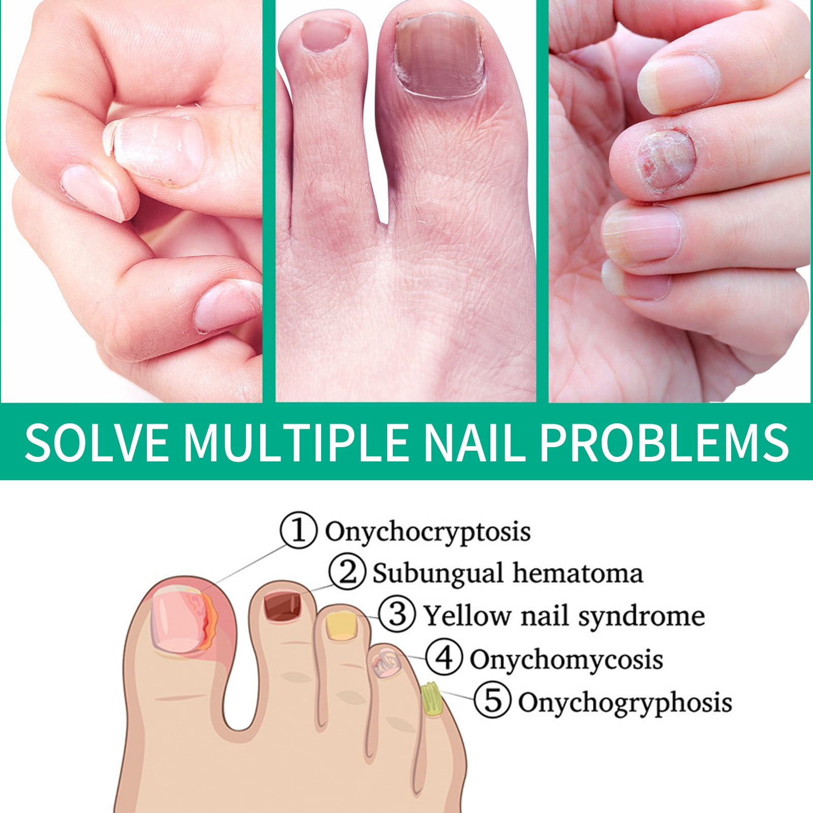 Dermoscopic Features of Green Nail Syndrome Associated with Dermatophytosis  and, Traumatic Onycholysis