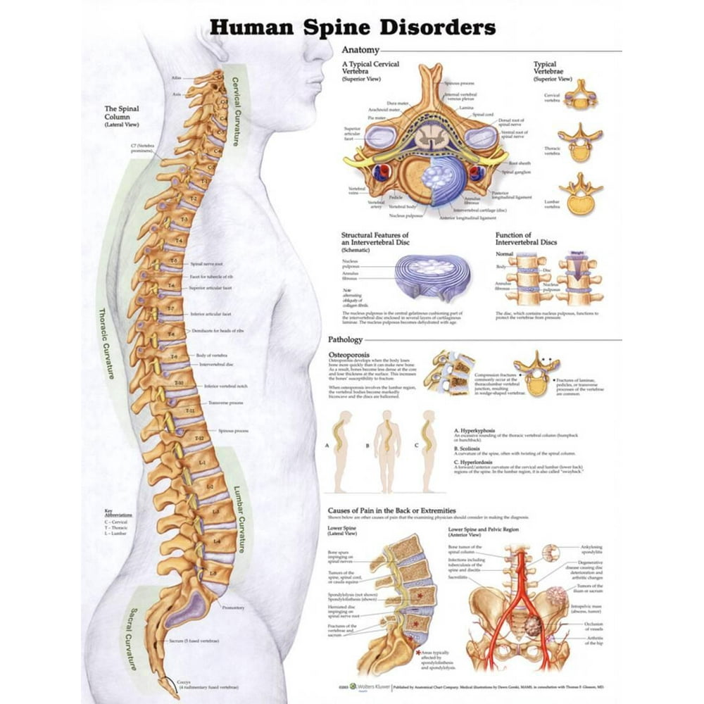 Human Spine Disorders Anatomical Chart Poster Print Poster - 20x26 - Walmart.com - Walmart.com