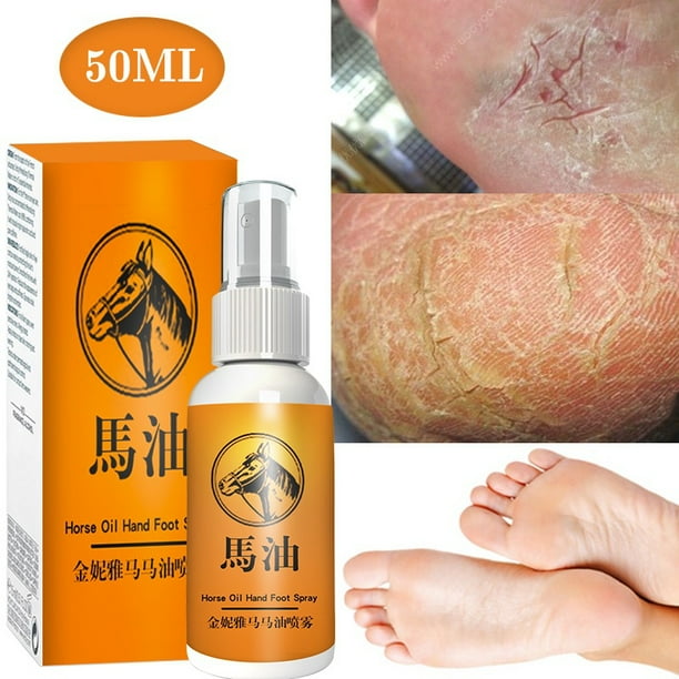 Spray Para Pies A Base De Hierbas Anti Hongos Alivia La Crema Beriberi Cuidado De La Piel Tratamiento Del Dedo Pie Infección Micótica Reparación De