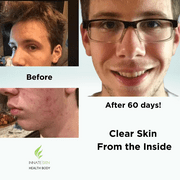 Innate Skin Acne System, 60 Piece, 2 Pack