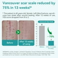 thumbnail image 4 of Dimora Silicone Scar Sheets, Extra Long Silicone Scar Tape, Waterproof Scar Treatment, Scar Removal Strips for Surgical Scars, C-Section, Keloid, Tummy Tuck, 1.6”x120" Roll, 4 of 7