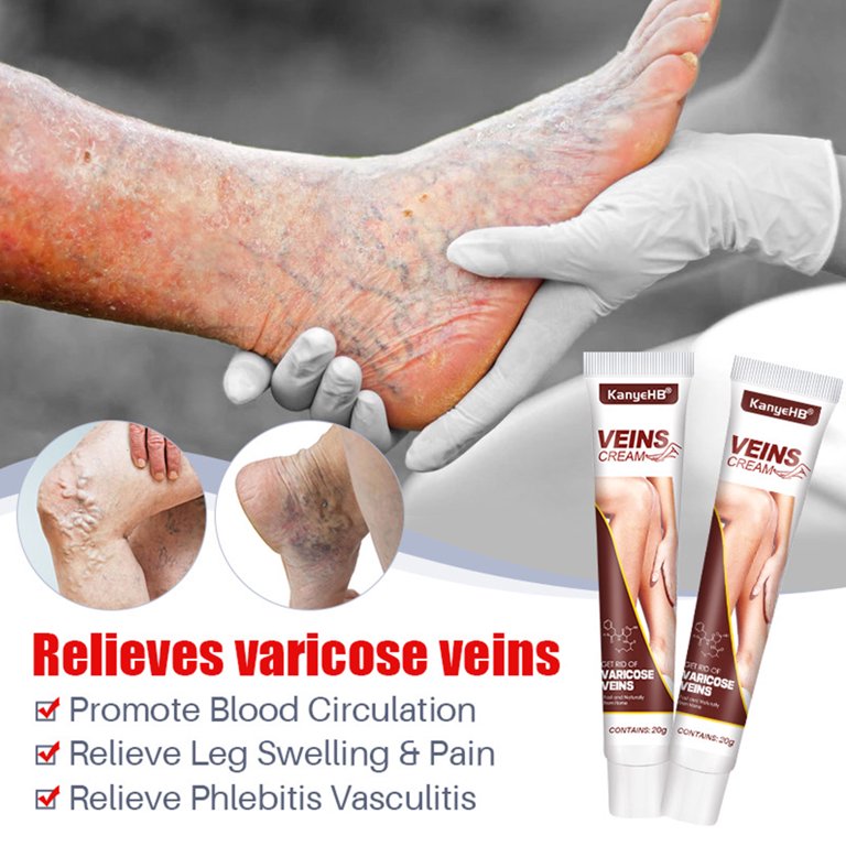 20g Varicose Vein Treatment Cream Promotes Smooth Skin Easy to Use Relief  Phlebitis Angiitis Leg Massage 