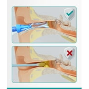 Medi Grade Ear Wax Removal Kit, Ear Syringe Ear Cleaner with 3 Quad-Stream Tips