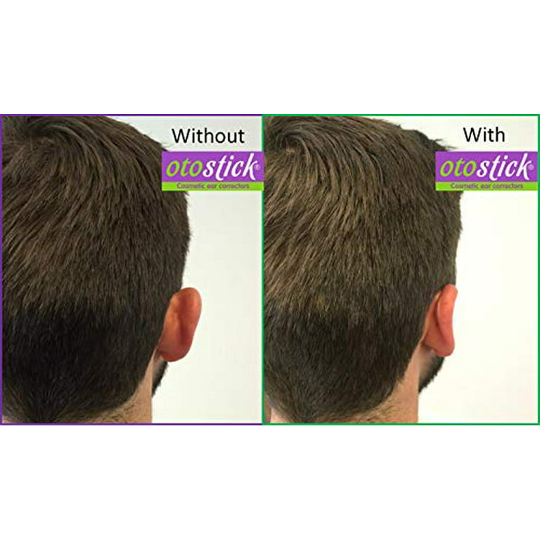Otostick Corrector for Protruding ears Easy and discreet solution