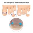thumbnail image 2 of 6Pcs/Box Ingrown Toenail Correction Wire Fixer Ingrown Toe Corrector Pedicure Treatment Care Tool, 2 of 4