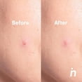 thumbnail image 3 of Parches Invisibles Para Granos Acne Nipskin 24 Piezas, 3 of 6