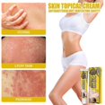 thumbnail image 2 of Crema reparadora de piel South Moon Versicolor para manchas de sudor, ungüento de aplicación tópica, crema antipicazón para la piel BF | |, 2 of 5