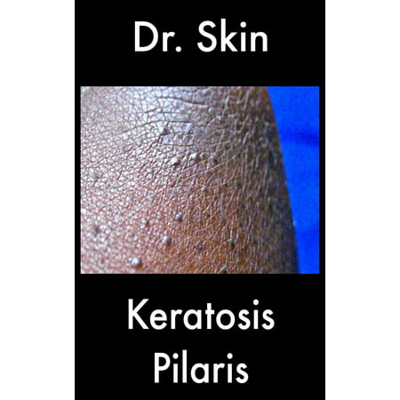 Keratosis Pilaris - eBook (Best Products For Keratosis Pilaris)