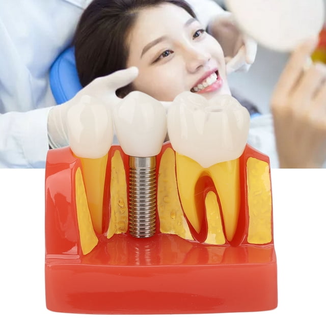 Modelo De Implante Dental, Modelo De Entrenamiento De Dientes De Implante, Demostración De Puente De Extraíble Para Profesionales Para Hospitales