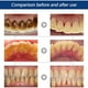 thumbnail image 3 of Calculus Cleaning Halitosis Stone Type Remove Teeth Whitening Dental Cleaning Water Remove Peculiar Smell And Calculus, 3 of 4