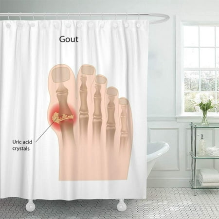 PKNMT Anatomy Gout the Big Toe Arthritis Inflammation Rheumatoid Crystals Joint Disease Bathroom Shower Curtain 66x72