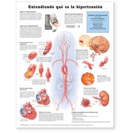 Understanding Hypertension Anatomical Chart in Spanish (Entendiendo Que Es la Hypertension)