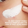 thumbnail image 5 of CeraVe Clay to Foam Acne Facial Cleanser, Mask & Spot Treatment for Acne Prone Skin 4 oz, 5 of 10