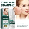 thumbnail image 2 of Promotional activities!Cystic, Hormonal, And Severe Acne Cream For Teens & Adults Acne With Special Acne Ingredients, 2 of 9