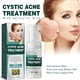 thumbnail image 1 of Crema para el acné quístico, hormonal y severo para adolescentes y adultos Acné con ingredientes especiales para el acné, 1 of 4