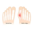 thumbnail image 4 of keepw Silicone Toe Separator Cushion Forefoot Pad for Correcting Toes Foot Care  No.2, 4 of 7