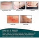 thumbnail image 3 of Silicone Scar Sheets for Post-Surgery, C-Section, Burns, and Keloids - 4cm x 3m Roll, 3 of 5