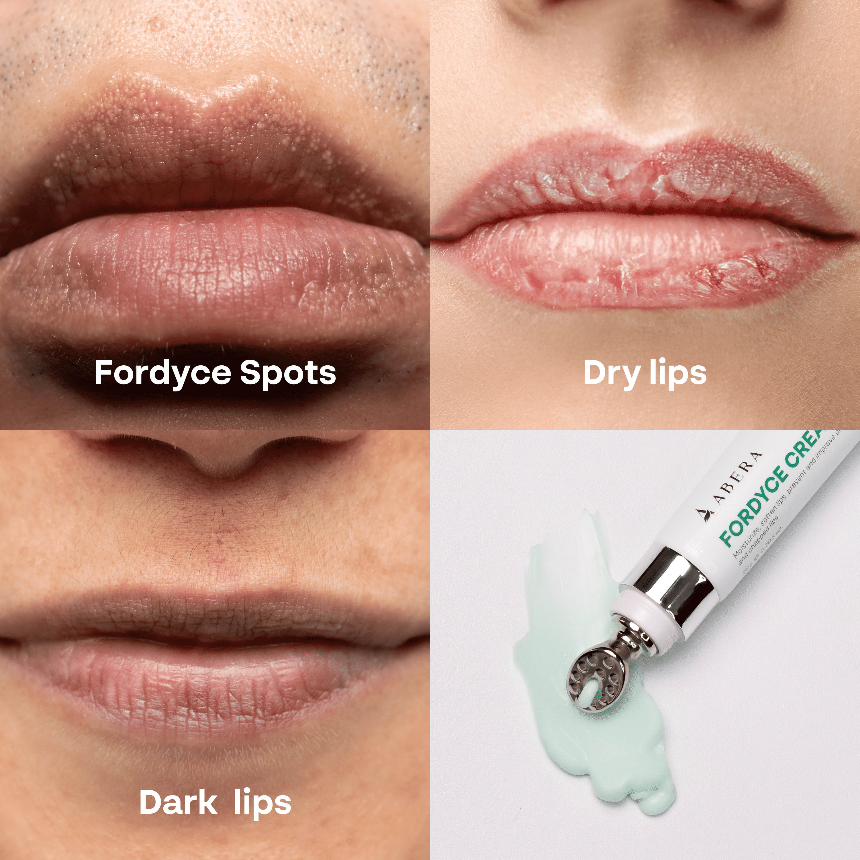 ABERA Fordyce Spot Lip Cream with HPR Retinoid, Moisturizing Repair For Dry Chapped Lips, 0.7 fl oz - Combo 2