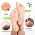 thumbnail image 4 of FootCure Tea Tree Foot Soak & Callus Remover Gel Kit - Remove Calluses with Epsom Salts, Callus Remover Gel for Dry Cracked Heels, 4 of 10