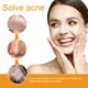 thumbnail image 3 of Jumpingount Parche para el acné Facial, pegatinas universales para la frente, cuidado de la piel, belleza, eliminación autoadhesiva, parches Tratamientos faciales, 3 of 6