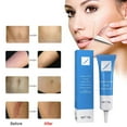 thumbnail image 2 of Scar Removal Stretch Marks and Burns Mark Removal, 2 of 8