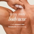 thumbnail image 2 of Spray para Acné Corporal First Aid Beauty con 2% de Ácido Salicílico 90 ml, 2 of 9