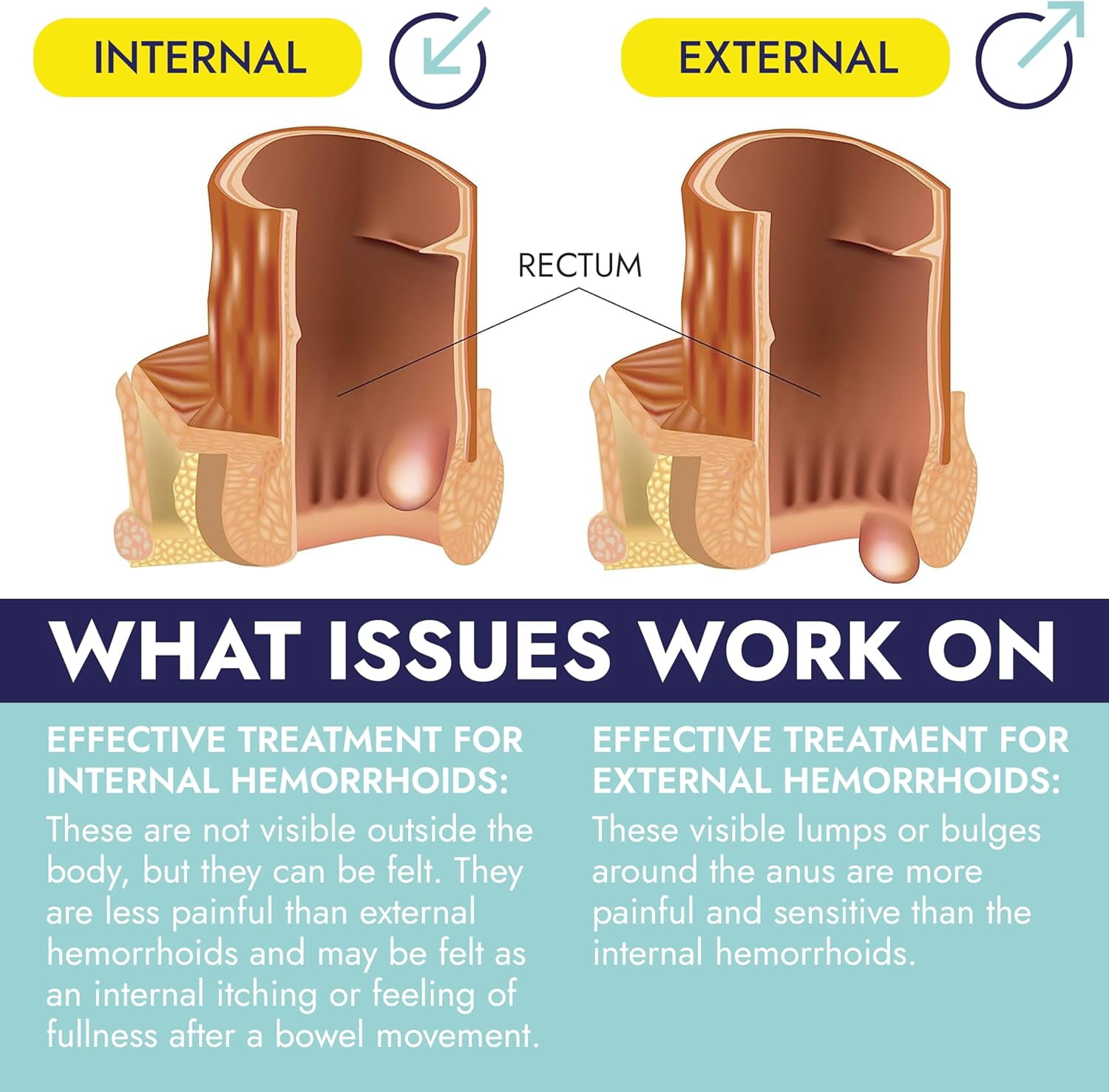 Hemorrhoid Treatment | Hemorrhoid Ointment | Hemorrhoid & Fissure Ointment