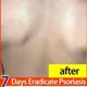 thumbnail image 5 of Ungüento chino tradicional para picazón de la piel, pomada para el tratamiento de infecciones por hongos, medicina para alergias, Psoriasis, Eczema, 5 of 5