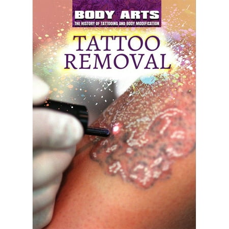 Tattoo Removal (Best Tattoo Removal In The World)