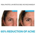 thumbnail image 2 of Sistema de tratamiento del acné La Roche-Posay Effaclar, 3 pasos, 2 meses, 2 of 7