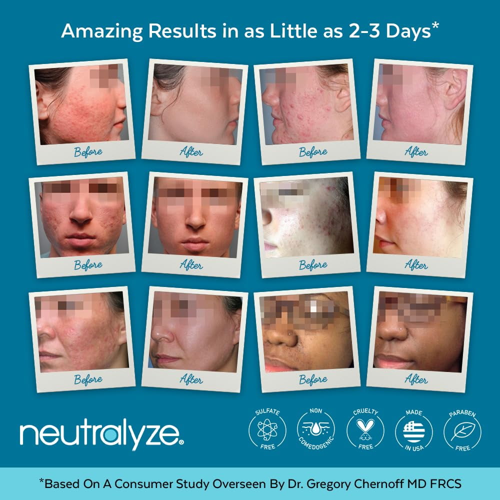 Neutralyze Renewal Complex Acne Moisturizer for Face - Time Released, Medical Grade 2% Mandelic Acid & Salicylic Acid Moisturizer Cream - Face Moisturizer for Acne Prone Skin (90+ Day)