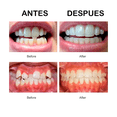 thumbnail image 3 of Retenedor De Dientes Para Corrección De Sonrisa 3 Etapas, 3 of 6