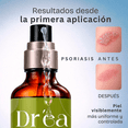 thumbnail image 5 of Amáre Gel dermolimpiador para piel con brotes e irritación recurrente, 5 of 5