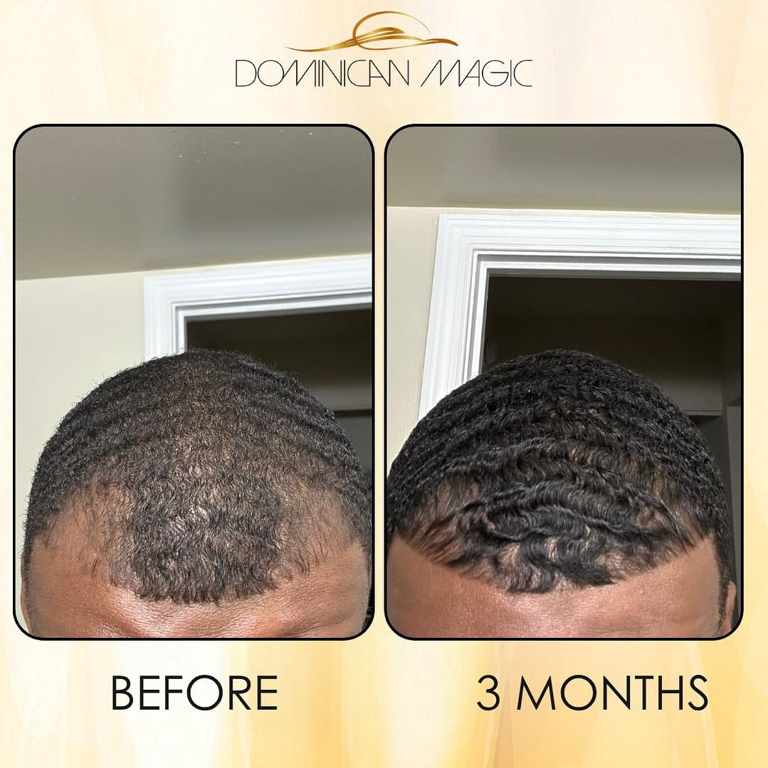Dominican Magic Hair Follicle Anti-Aging Scalp Drop Hair Tonic with Rosemary and Cinnamon, Gotero Anti-Caida, Helps Stimulate Hair Growth