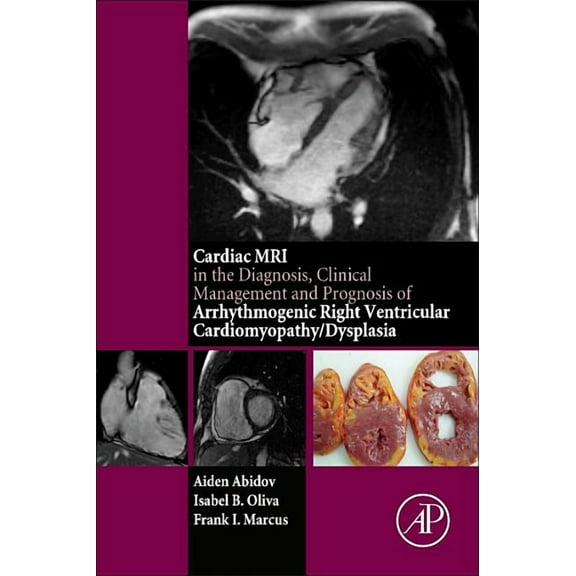 Cardiac MRI in Diagnosis, Clinical Management, and Prognosis of Arrhythmogenic Right Ventricular Cardiomyopathy/Dysplasi, (Paperback)
