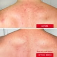 thumbnail image 4 of Spray para Acné Corporal First Aid Beauty con 2% de Ácido Salicílico 90 ml, 4 of 9