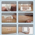 thumbnail image 4 of Zipper Band-Aid for Painless Wound Closure - Suture-Free Dressing Patches, Zip Suture Reducer, Band Aid for Quick Healing, 4 of 5