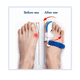 thumbnail image 3 of Kit De Correctores De Juanete Y Protectores color blanco, 3 of 4
