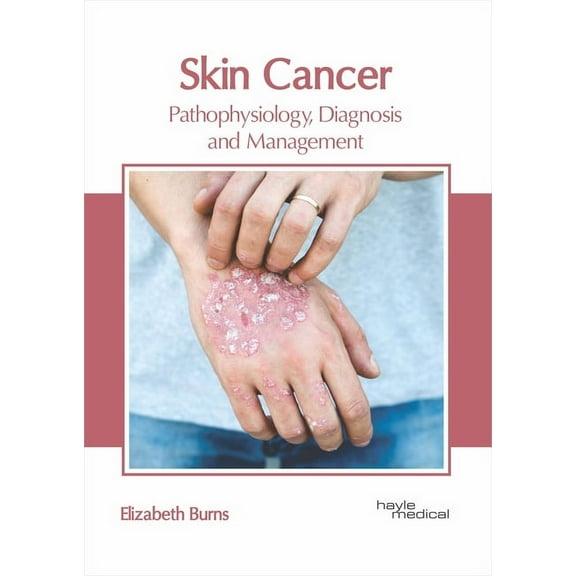 Skin Cancer: Pathophysiology, Diagnosis and Management, (Hardcover)