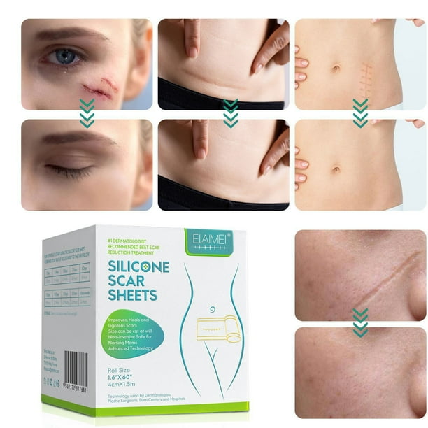 Wmkox8yii Parche de silicona para cicatrices, rollo de cinta de silicona para cicatrices, tira de silicona para cicatrices, eliminador de cicatrices reutilizable para cesáreas, queloides, etc. 1,5 m Wmkox8yii FJKAFA2472
