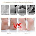 thumbnail image 3 of Tutuviw Brand Quality Corn Plane Callus Remover,Shaver Cutter Eliminator Razor With 10 Extra Sharp Refill Blades, Professional Pedicure Foot Care, 3 of 8