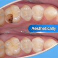thumbnail image 3 of Dental Cement for Tooth Repair and Cavity Filling with Enhanced Strength and Restoration, 3 of 3
