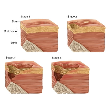 4 Stages of a Bedsore Illustration Rolled Canvas Art - Gwen ShockeyScience Source (24 x