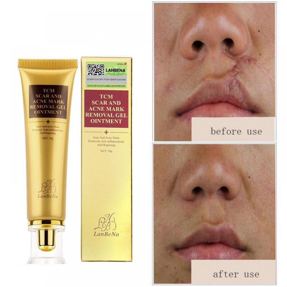 best lotion for removing scars