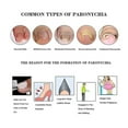 thumbnail image 2 of CHAO Fundas correctoras para uñas encarnadas, 4 pares de herramientas de corrección de silicona elástica, 2 of 2