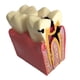 thumbnail image 3 of Modelo De Herramienta De Enseñanza Cariados Dispensión Gingival Modelo 2 DYNWAVEMX Molde de estudio de compactación de caries, 3 of 5