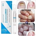 thumbnail image 3 of 3 ML Nail Repair Liquid Pen With Brush Gentle Anti Fungal Remover Onychomycosis, 3 of 4