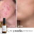 thumbnail image 4 of Serum 47 hidratante facial para eliminar el acné y las cicatrices, 30 ml, 4 of 8
