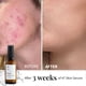 thumbnail image 4 of Serum 47 hidratante facial para eliminar el acné y las cicatrices, 30 ml, 4 of 8